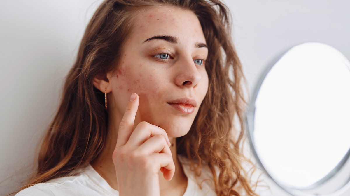 Os 14 melhores cremes para eliminar borbulhas e acne 1 Os 14 melhores cremes para eliminar borbulhas e acne