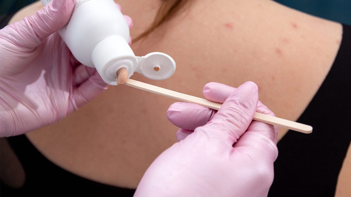 Acné corporal: causas y los mejores productos para eliminarlo de raíz