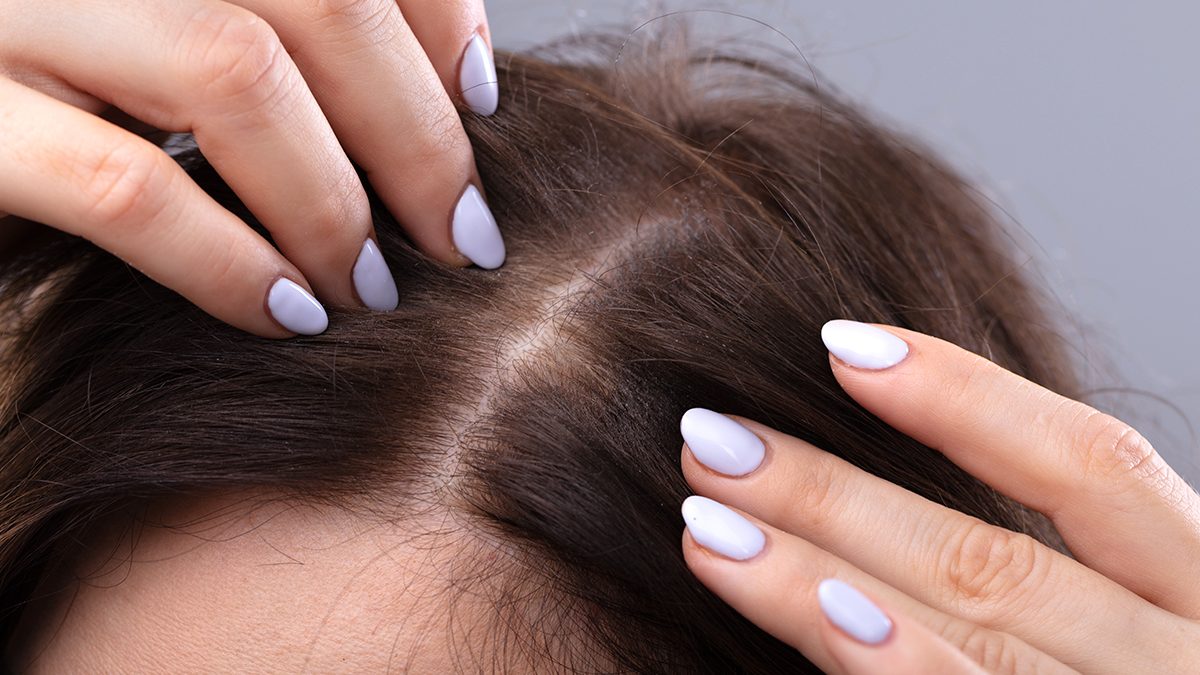 Cómo quitar la caspa del pelo: motivos por los que aparece y los mejores productos para eliminarla