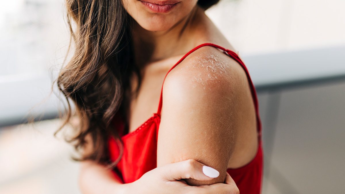 Alergia al sol: síntomas, causas y los mejores trucos para aliviarla