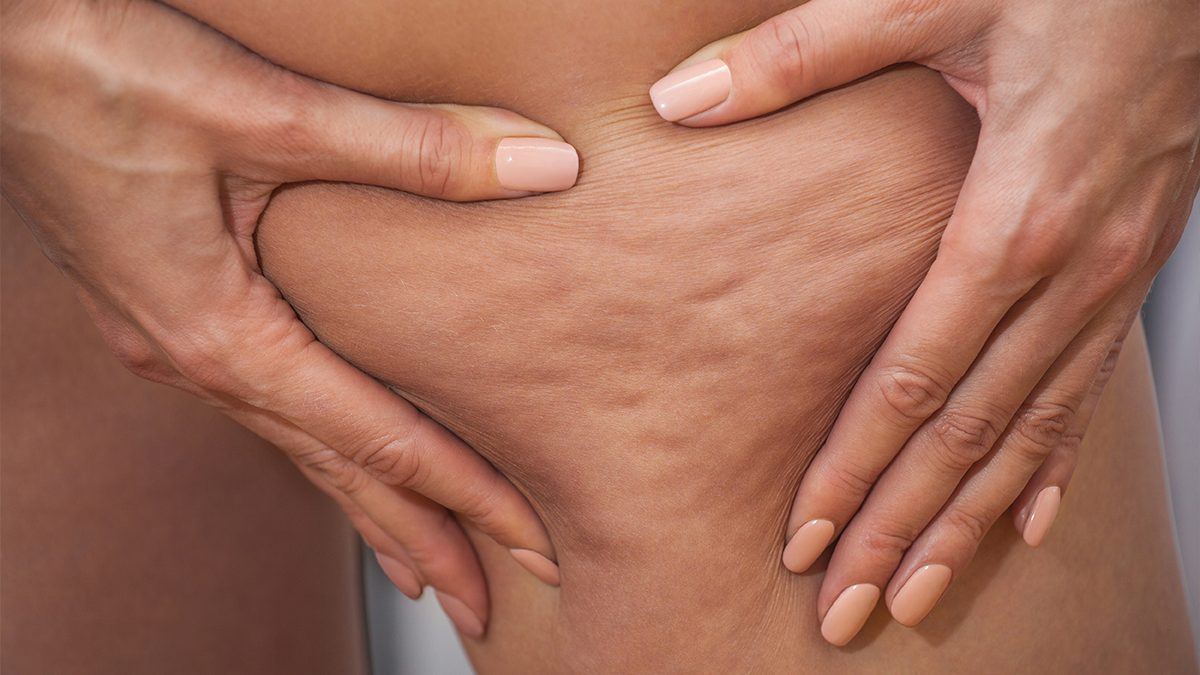 Celulitis en el embarazo: cómo puedes evitarla