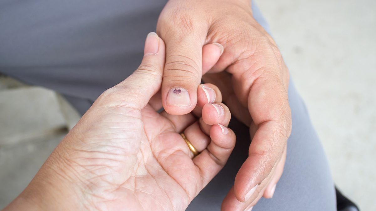¿Manchas negras en las uñas? Por qué salen y cómo vas a poder eliminarlas