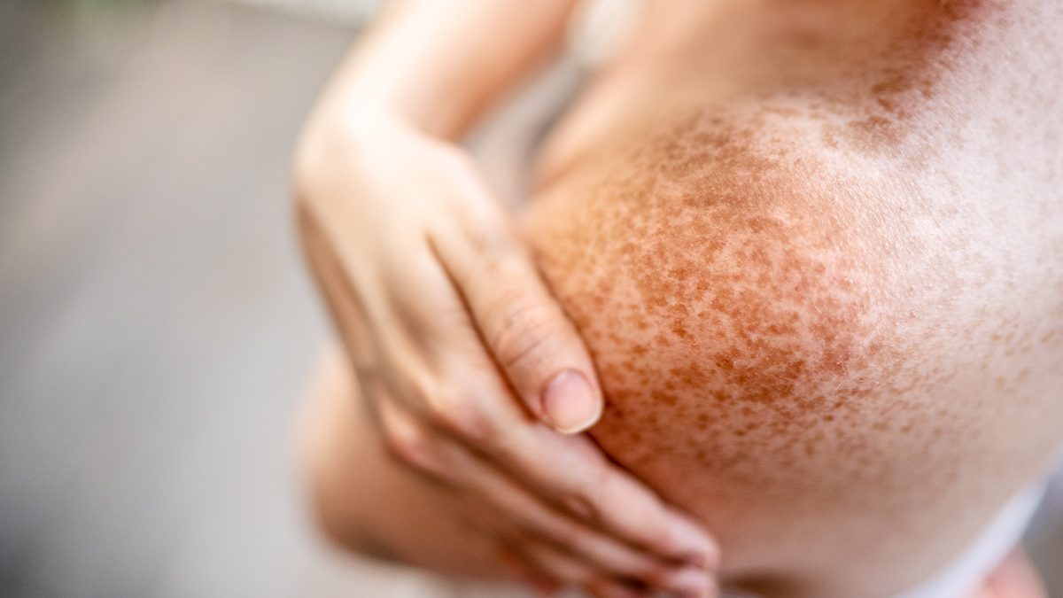 Manchas solares en 2026: cuidado y prevención para cada tipo de piel