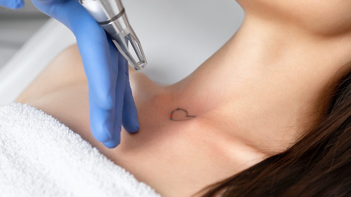 Eliminar un tatuaje permanente: todo lo que debes tener en cuenta