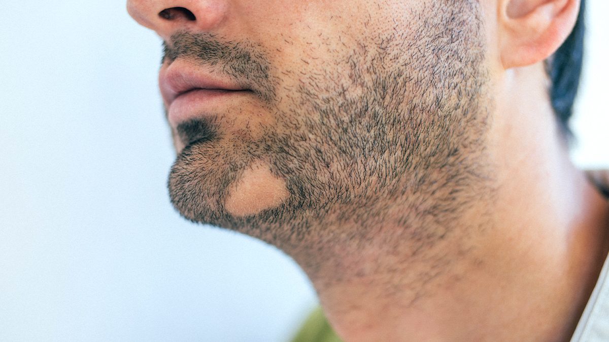 Alopecia areata: qué es y cómo solucionar las calvas en la barba