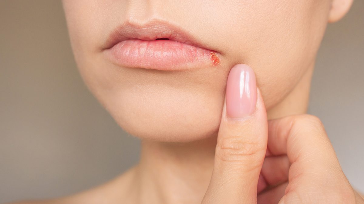 Herpes labial: por qué sale y cómo tratarlo