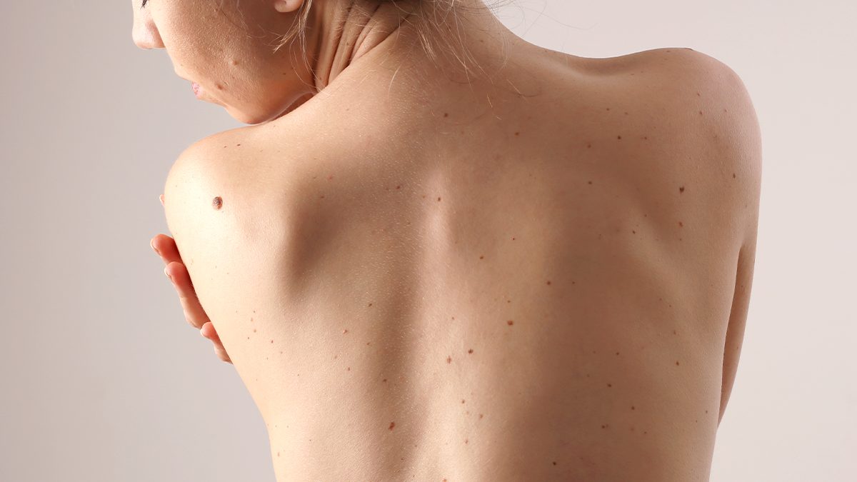 Los 4 mejores productos corporales si tienes muchas pecas