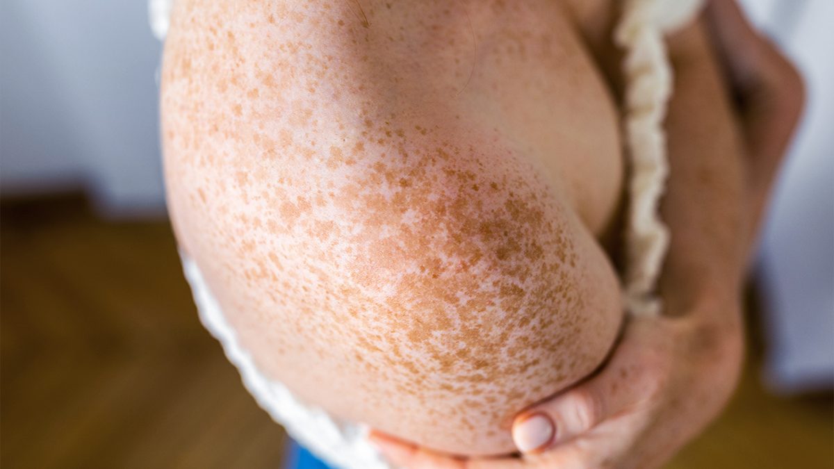 Cómo proteger del sol las pieles con pecas y lunares: qué dicen los expertos en 2026