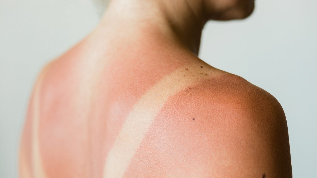 ¿Por qué me pongo rojo cuando tomo el sol?