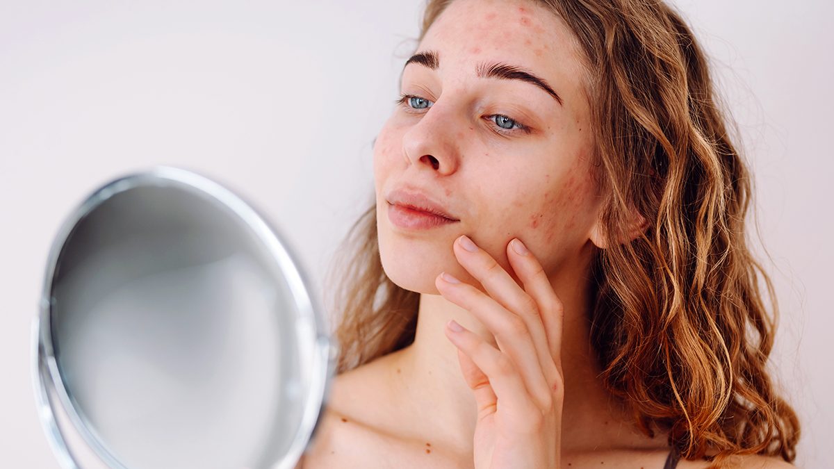 Si tienes psoriasis en la cara, así es cómo debes tratarla