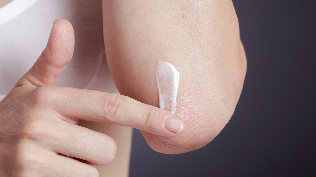 ¿Cómo tratar la psoriasis en los codos?
