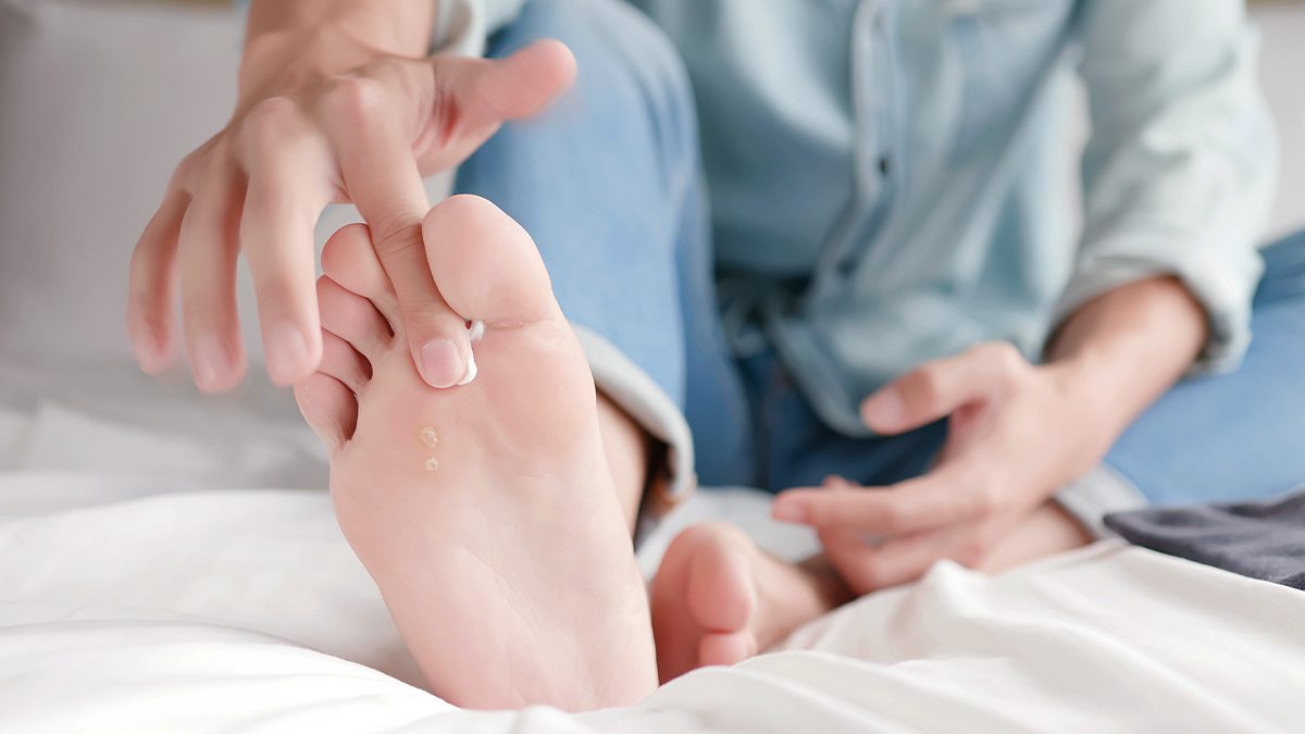 ¿Cómo tratar la psoriasis en los pies?