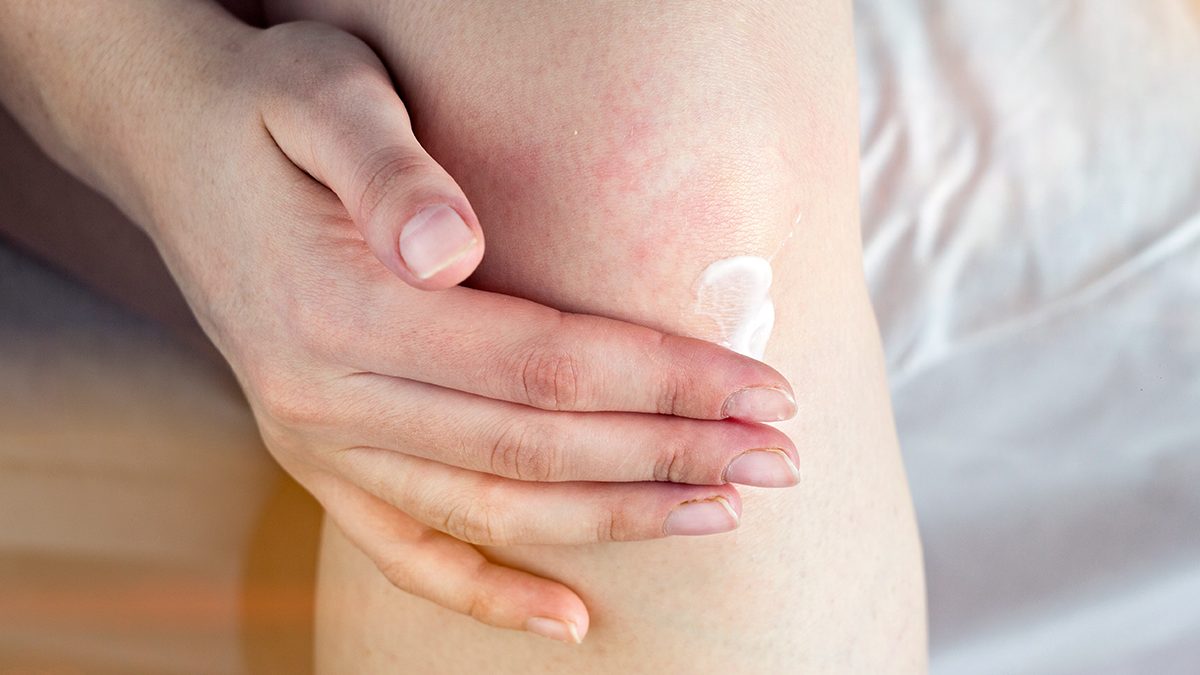 ¿Cómo tratar la psoriasis en las rodillas?