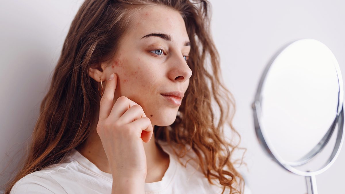 Cicatrices del acné: por qué salen y cómo podemos prevenirlas según expertos