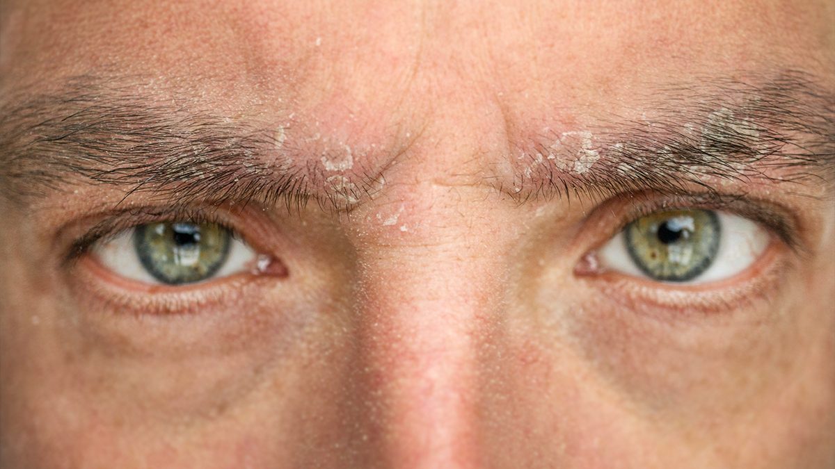 Cómo tratar la dermatitis seborreica en las cejas