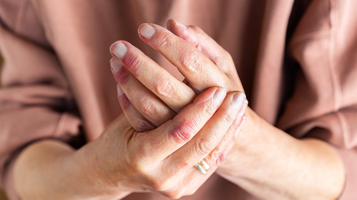 Cómo tratar la psoriasis en las manos