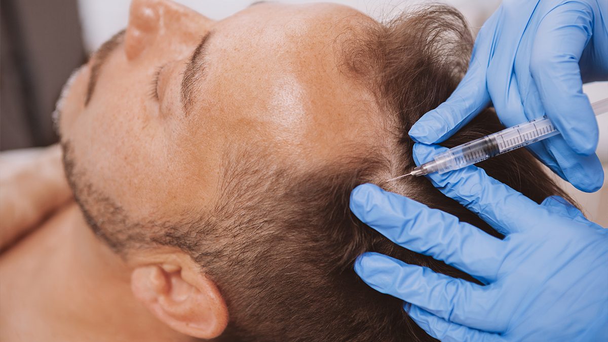 Lo que debes saber si te quieres hacer injertos de pelo
