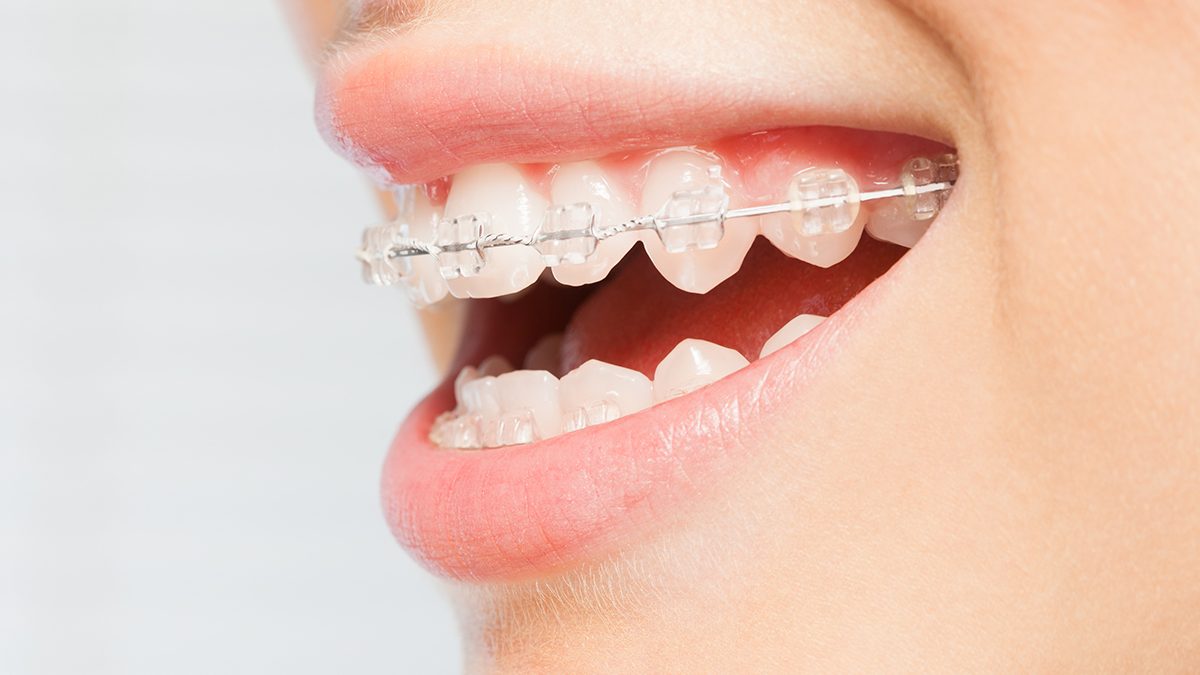 Si tienes ortodoncia, estos son los pasos que debes seguir para cepillarte bien los dientes