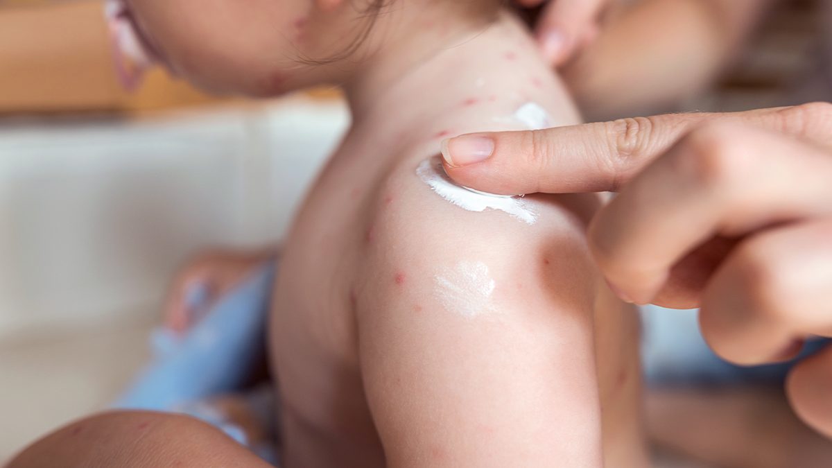 Los mejores consejos y productos para aliviar los molestos síntomas de la varicela