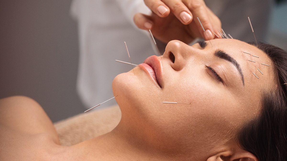 Acupuntura: la historia y los beneficios de esta práctica milenaria
