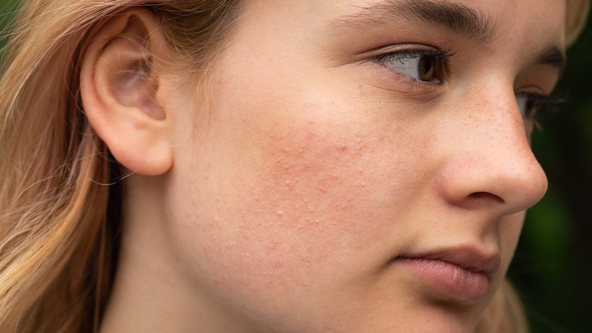 Pústulas: qué son, por qué salen y cómo tratarlas