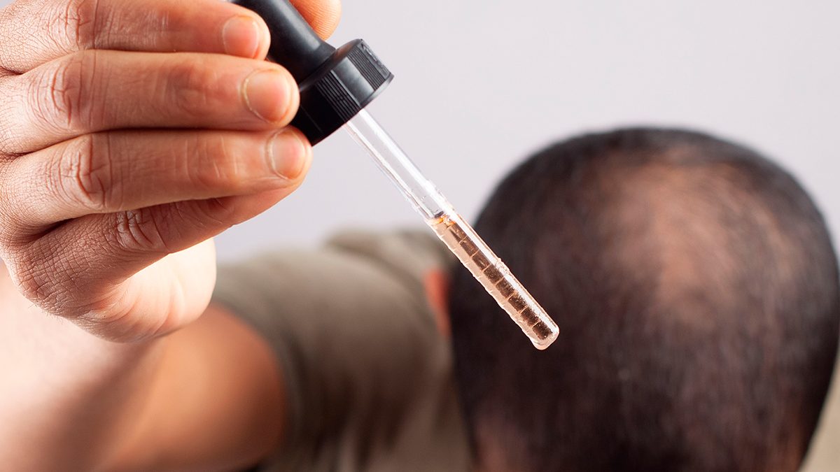 No a todos los cabellos le sienta bien el minoxidil: esta es una lista de los activos similares