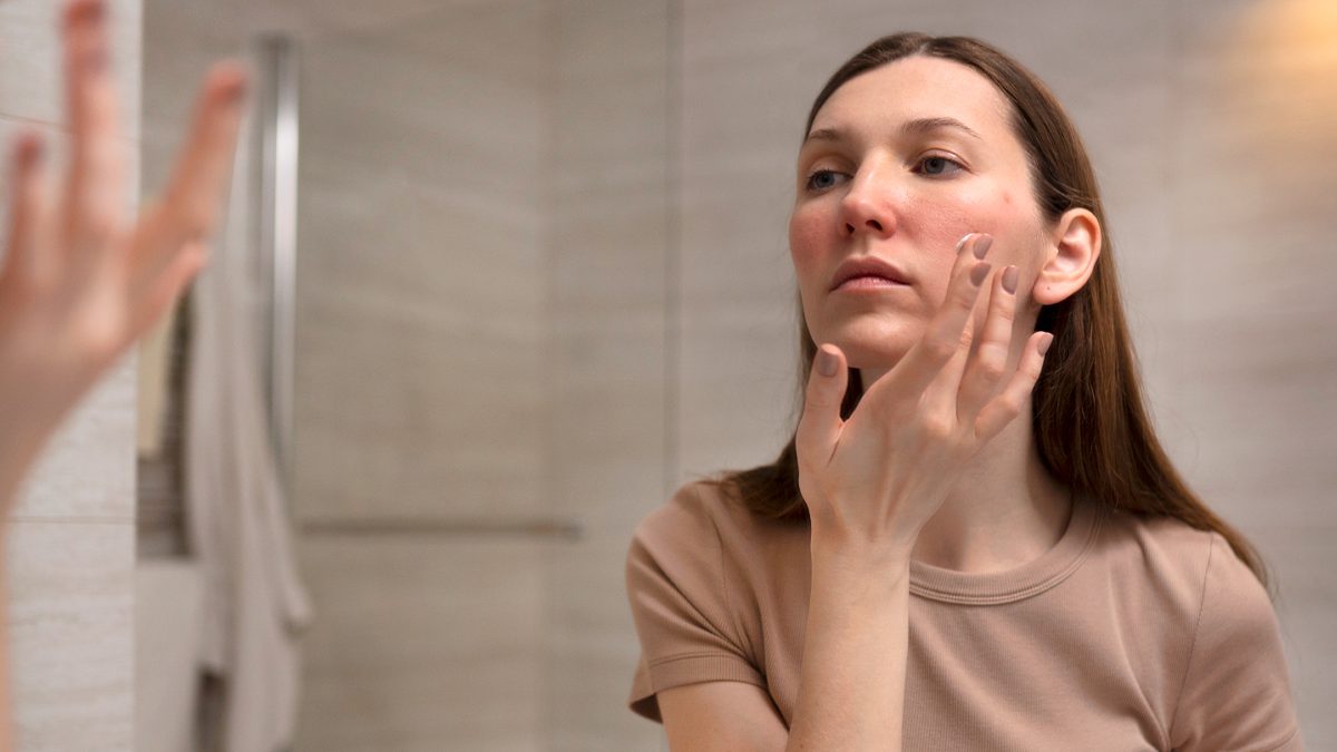 Dermatitis perioral: qué es, cuáles son sus síntomas y cómo tratarla