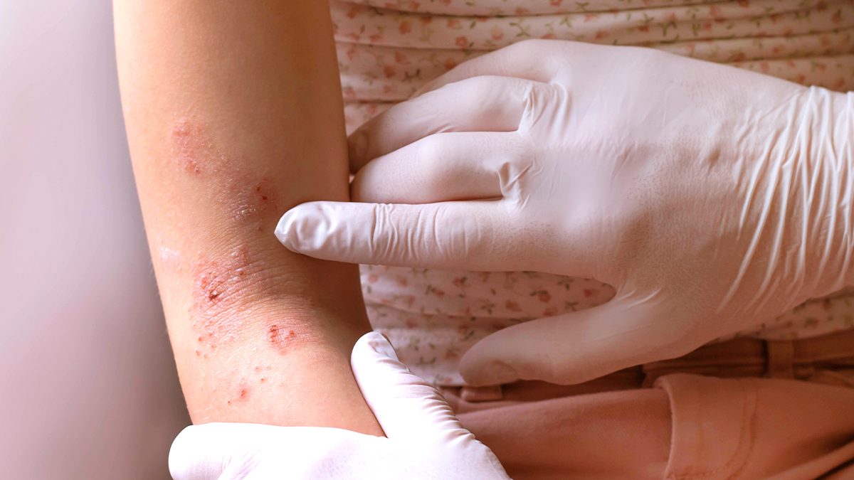 Eczemas: qué son, por qué aparecen y cuáles son sus síntomas